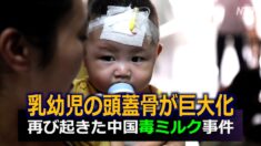 乳幼児の頭蓋骨が巨大化 再び起きた中国毒ミルク事件