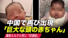中国で再び「巨大な頭の赤ちゃん」出現 生後６か月の女児が巨頭症に